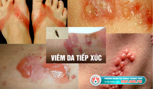 Viêm da tiếp xúc